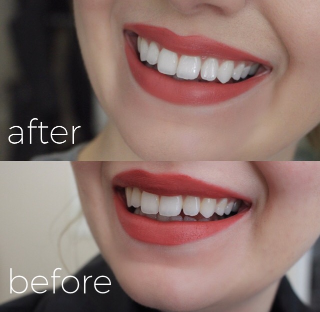 teeth whitening